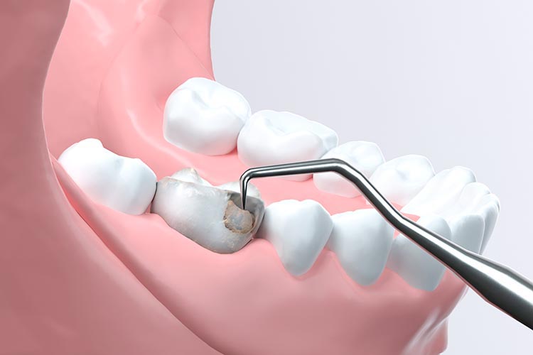 むし歯治療のイメージ画像