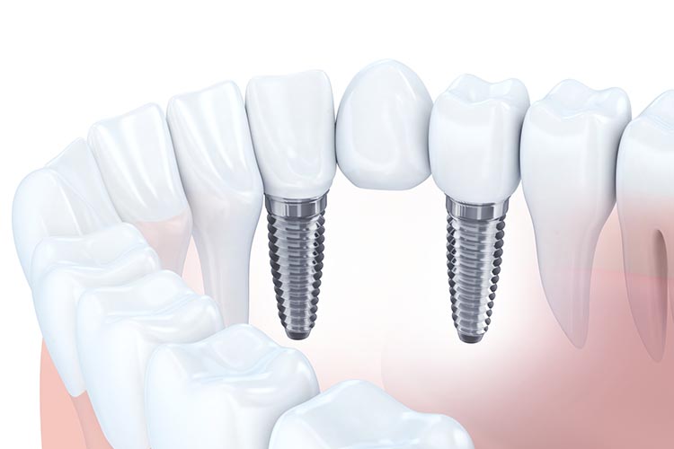 インプラント治療のイメージ画像