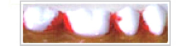 磨き残しのある歯の画像