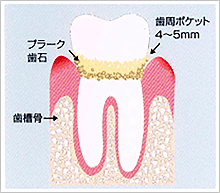軽度の歯周病の画像