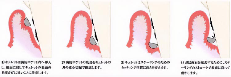 ①キュレットは歯周ポケット内へ挿入し、根面に対してキュレット表面の角度が0°に近いことに注意します。②歯周ポケットの底部をキュレットの刃の遠心切縁で確認します。③キュレットはスケーリングのためのカッティング位置に向きを変えます。④刃は歯石を除去するために、スケーリングのストロークで根面に沿って動かします。